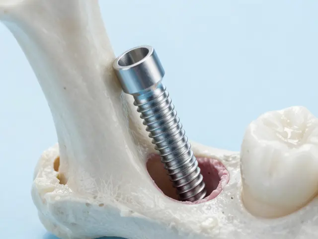 5 nejlepších výhod zubních implantátů: Proč jsou lepší než můstky?